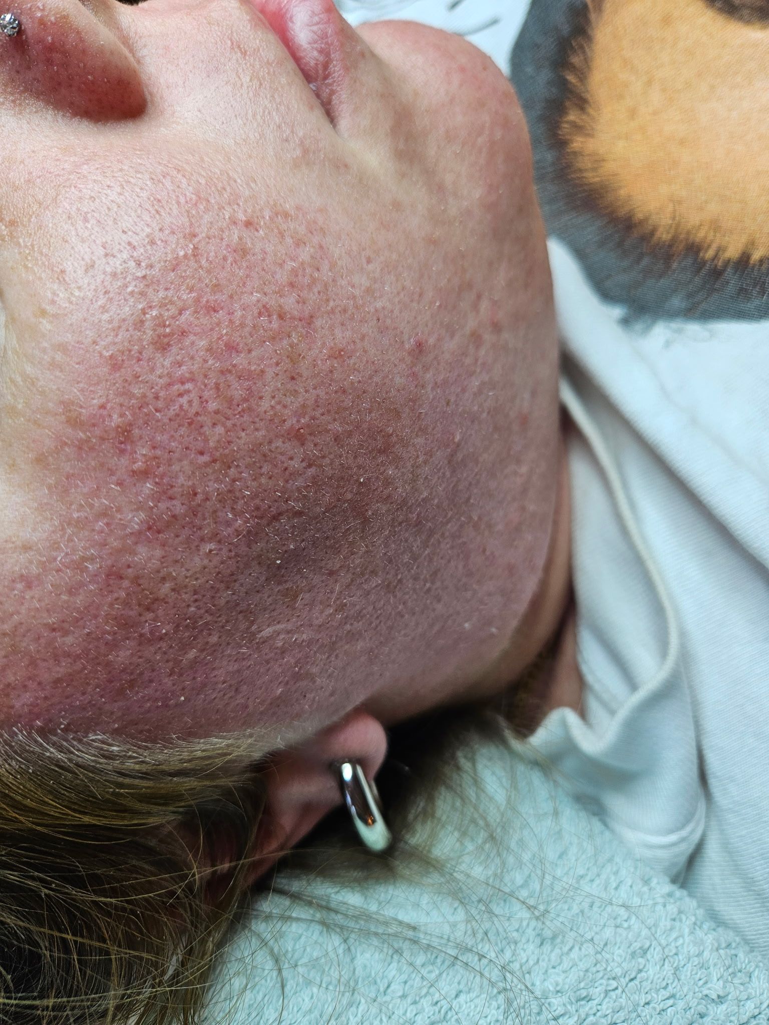 Close-up of a person's face showing red, irritated skin, with a silver earring visible.