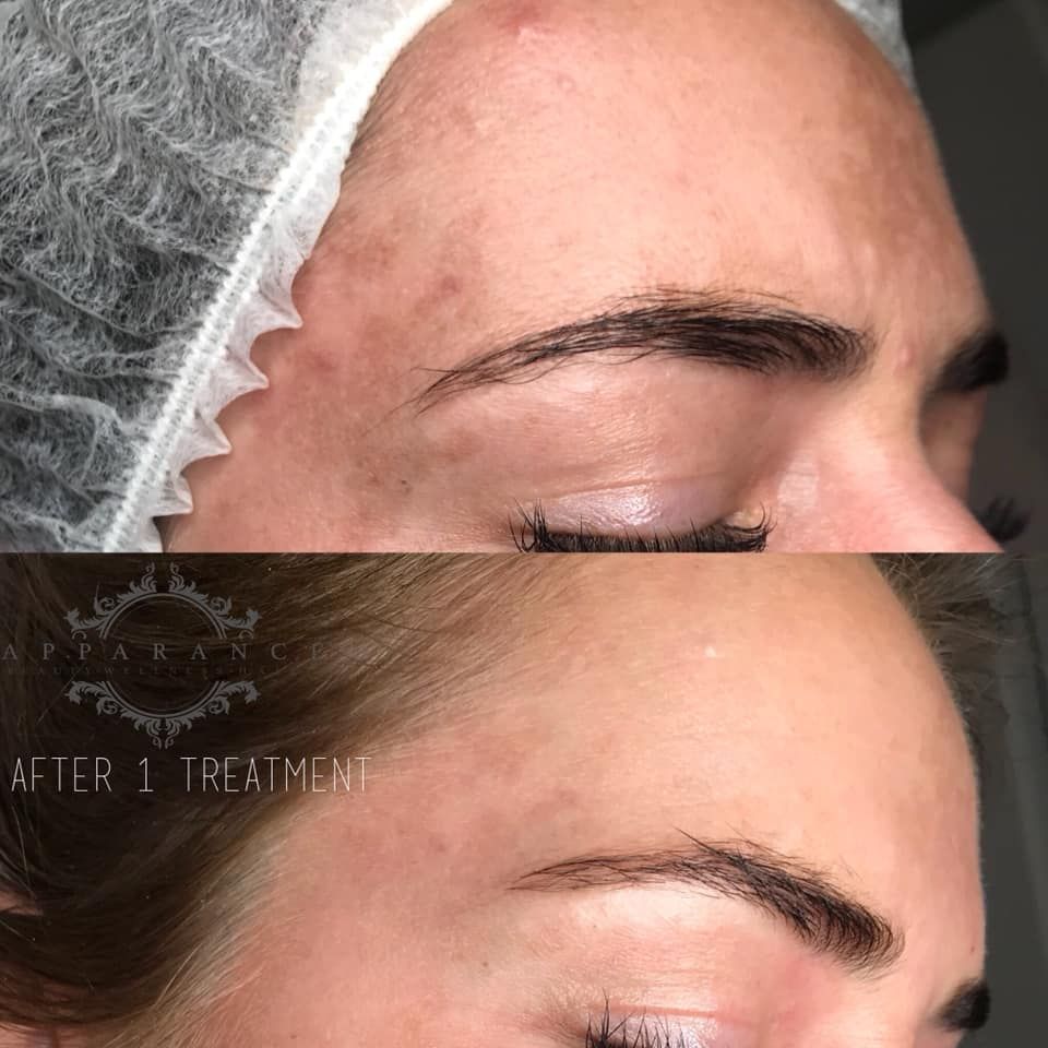 Meline pigmentbehandeling pigmentvlekken gezichtsbehandeling schoonheidssalon breda laseren