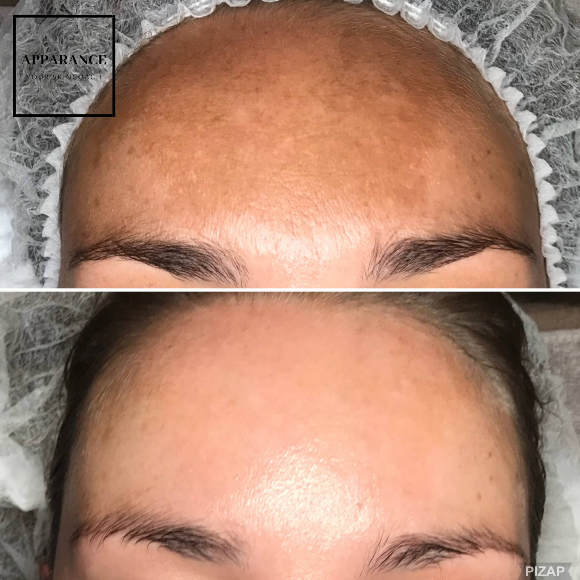 pigmentbehandeling meline pigmentvlekken verwijderen huidbehandeling apparance etten-leur breda zonder laser