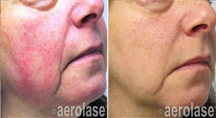 Before and after comparison of a woman's face, showing reduction in redness on the left side after laser treatment.