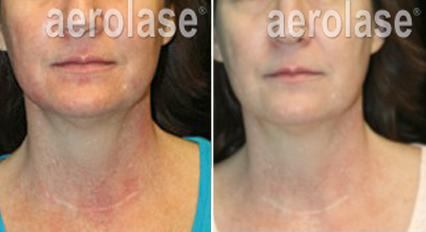 Before and after Aerolase laser treatment showing reduced redness on a woman's face and neck.
