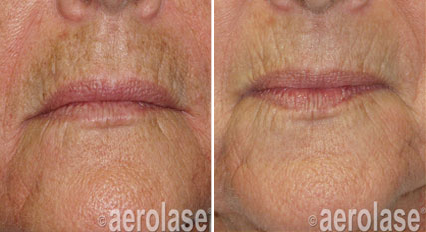 Before and after comparison of lips, showing reduction in sun damage and pigmentation.