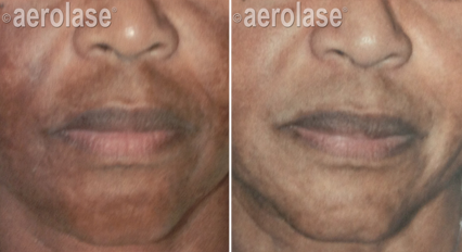 Before and after photos of a person's face showing lightening of hyperpigmentation around the mouth.