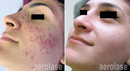 Acne before and after treatment on woman's face. Red blemishes on the left; clear skin on the right.