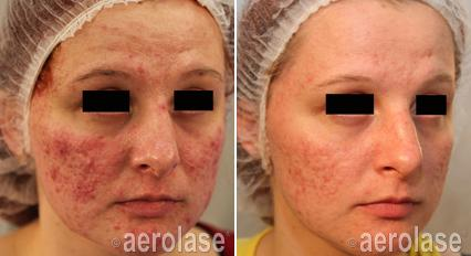 Before and after photos of a woman's face show reduced redness and improved skin texture from laser treatment.