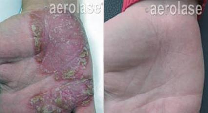 Hand with severe skin condition before and after laser treatment.
