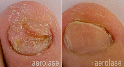 Comparison of a toenail with a fungal infection before (left) and after (right) treatment.