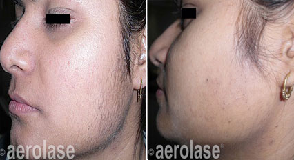Side-by-side photos show woman's face before and after facial hair removal.  Skin appears smoother in the 