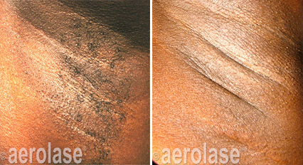 Before and after photos of skin underarm. Darker, discolored skin lightened after laser treatment.