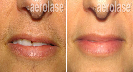 Before and after photos of a woman's lips: less wrinkles, fuller look after Aerolase treatment.