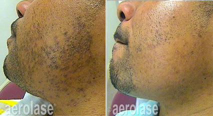 Before and after of a man's face. Reduction in beard shadow after laser hair removal.