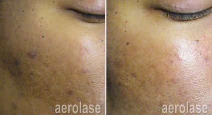 Before and after images of a face, showing reduction in skin discoloration and improved texture after Aerolase laser treatment.
