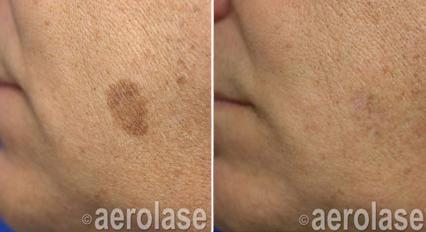 Before and after photos of a hand; the first shows a brown spot, the second shows clear skin.