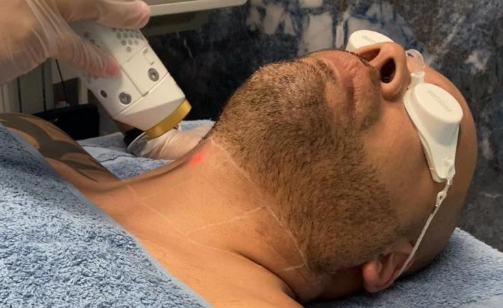 Person undergoing laser hair removal on neck. Wearing safety glasses. Skin is on a blue towel.
