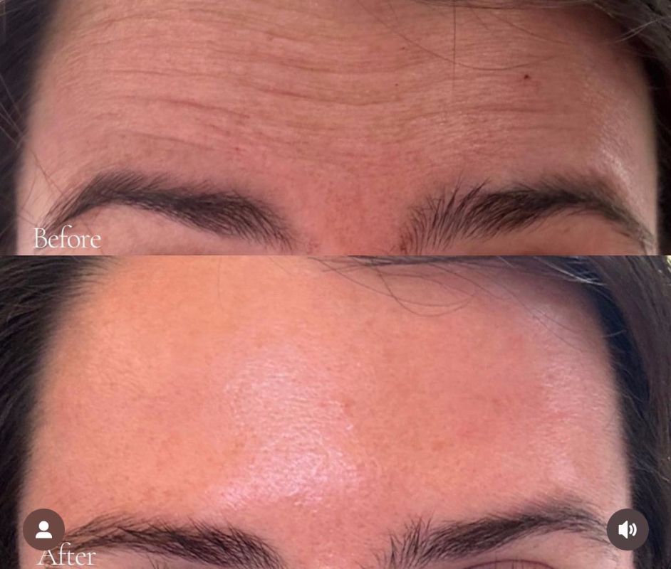 Comparison of forehead wrinkles before and after treatment.