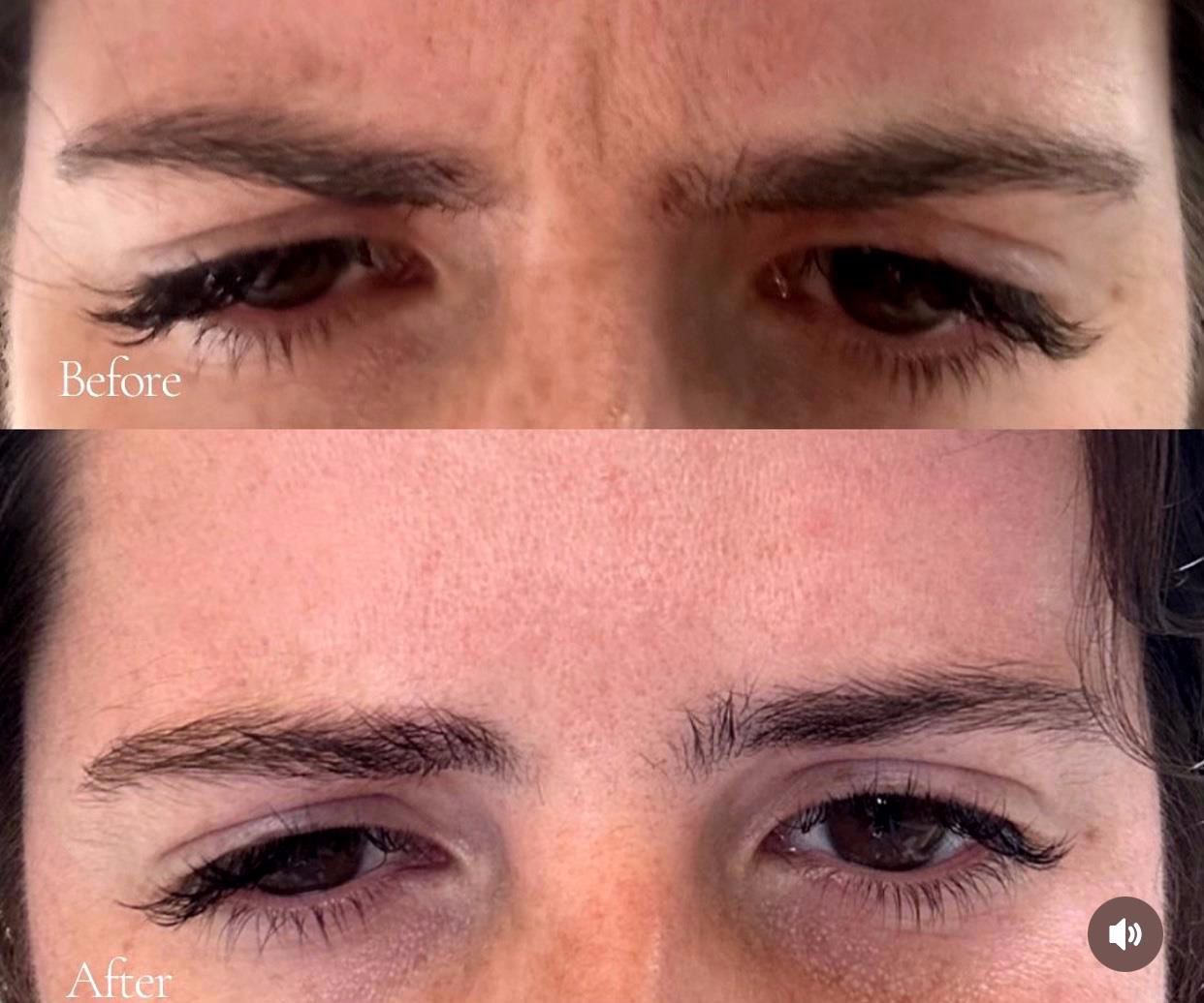 Before and after of a person's eyebrows, showing the reduction of frown lines through cosmetic treatment.