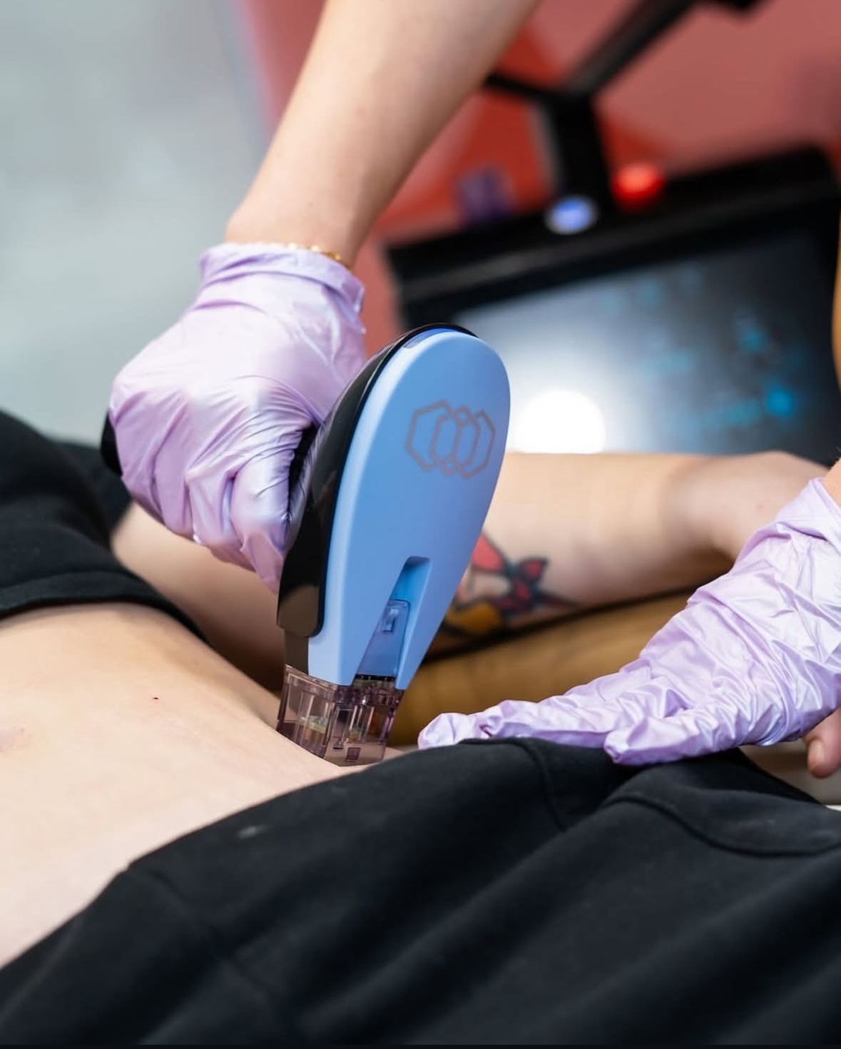 Person receiving treatment, hands in gloves using a blue device on the body.