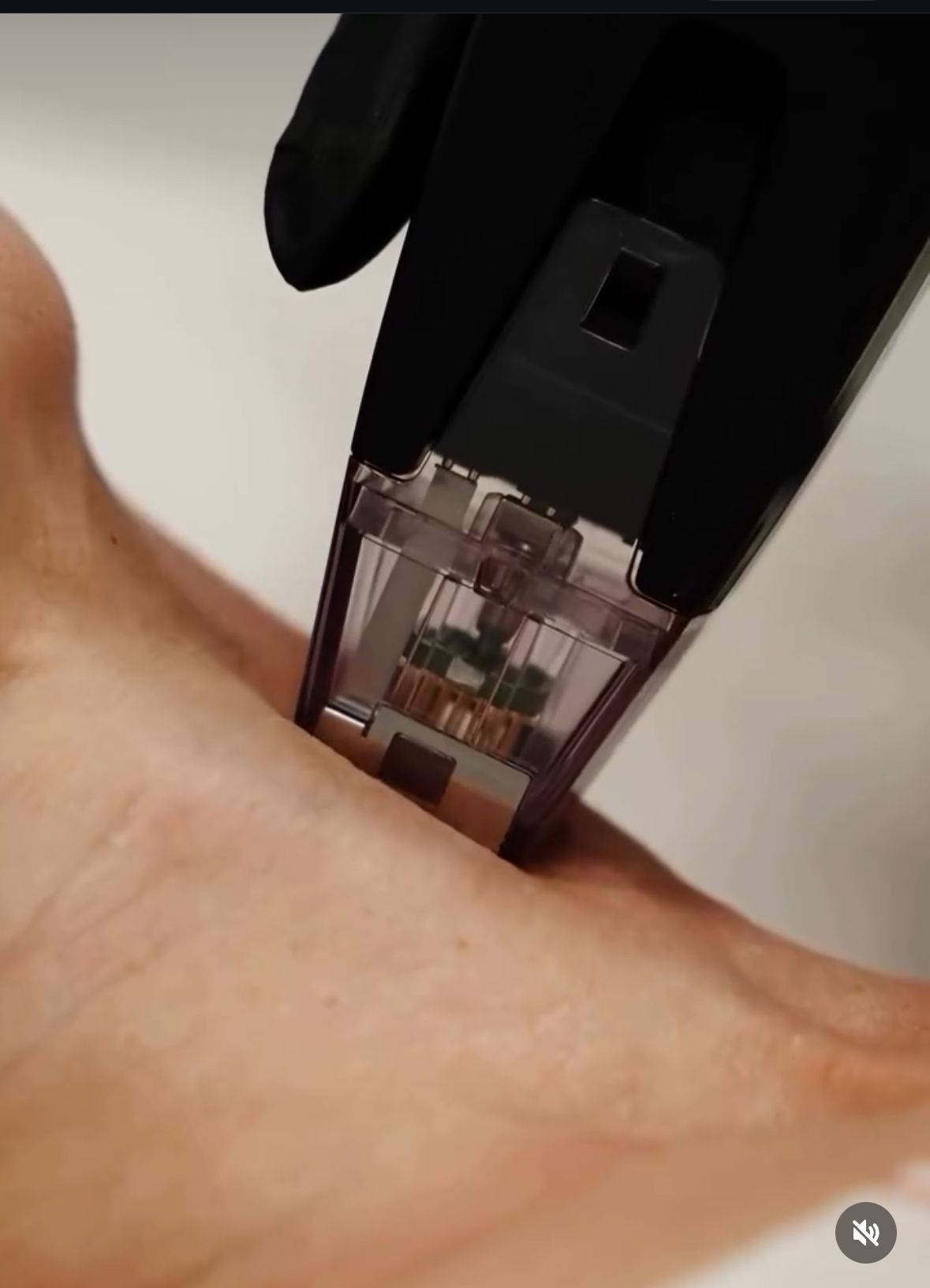 Black-gloved hand applying a micro-needling device to the top of a fair-skinned foot.