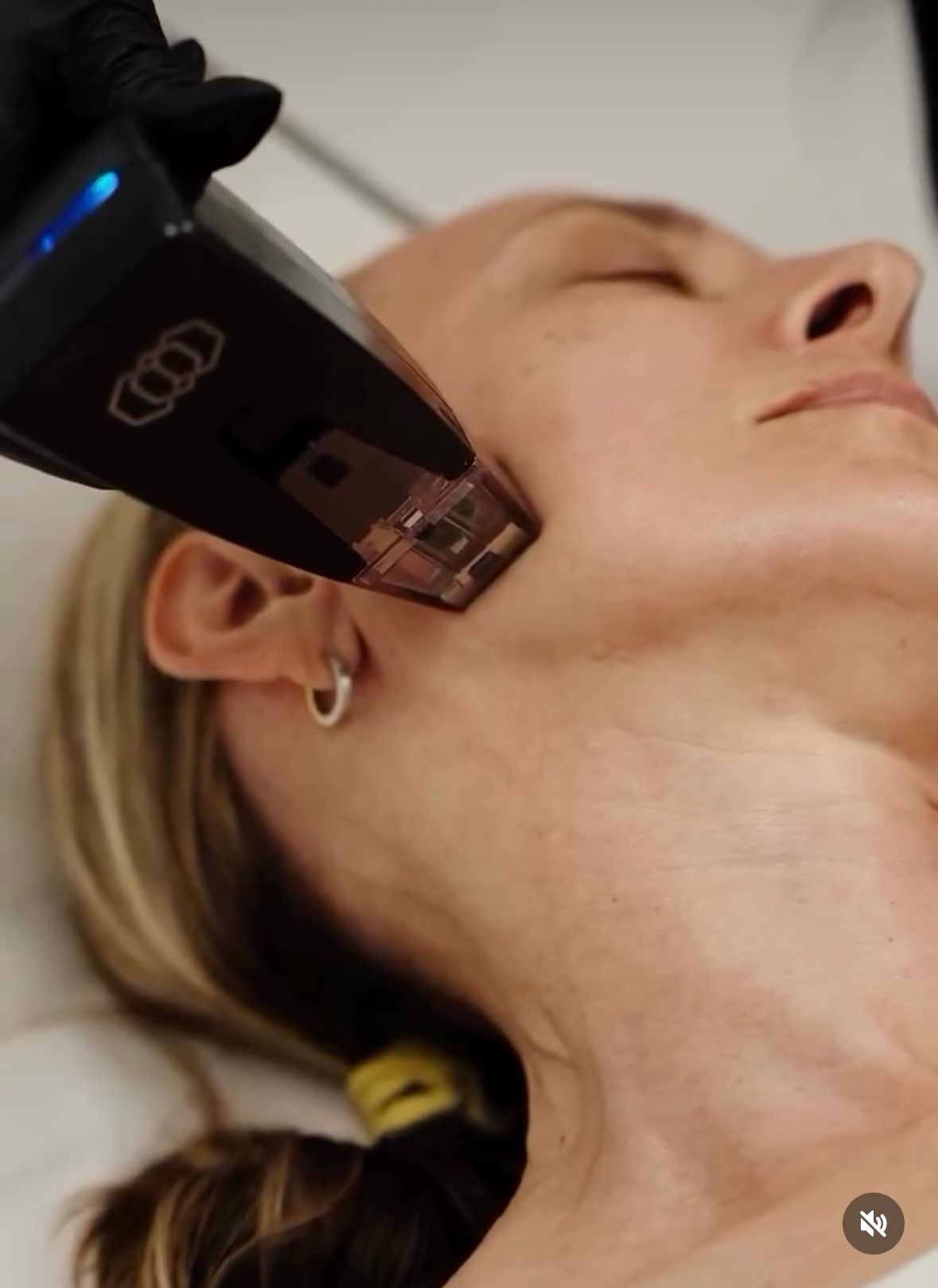 Woman receiving a skin treatment with a device on her cheek, in a clinical setting.