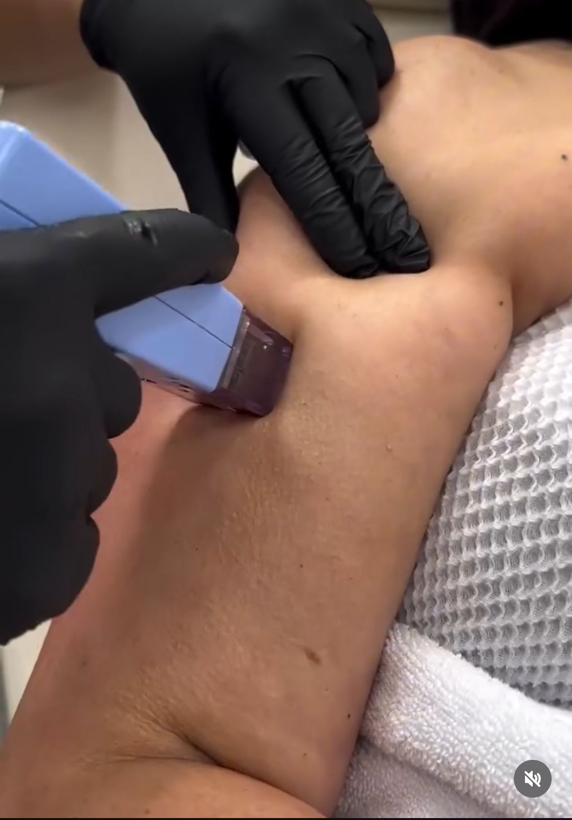 Person getting armpit waxed by someone wearing black gloves.