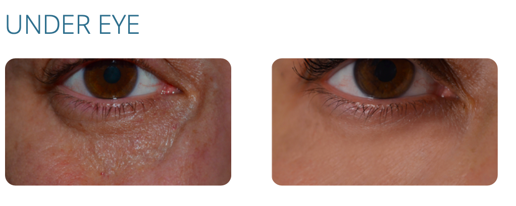 Before-and-after comparison of under-eye areas, showing reduction in wrinkles and darkness.