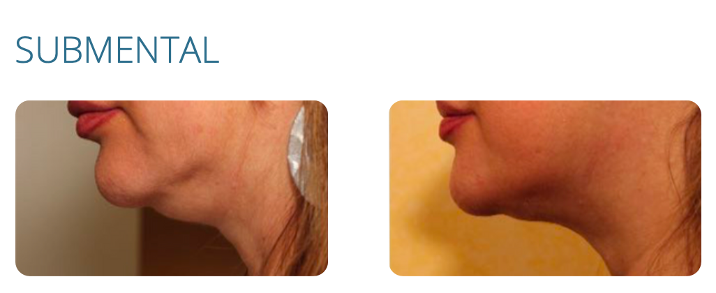 Before and after photos of woman's lower face, showing wrinkle reduction after cosmetic procedure.
