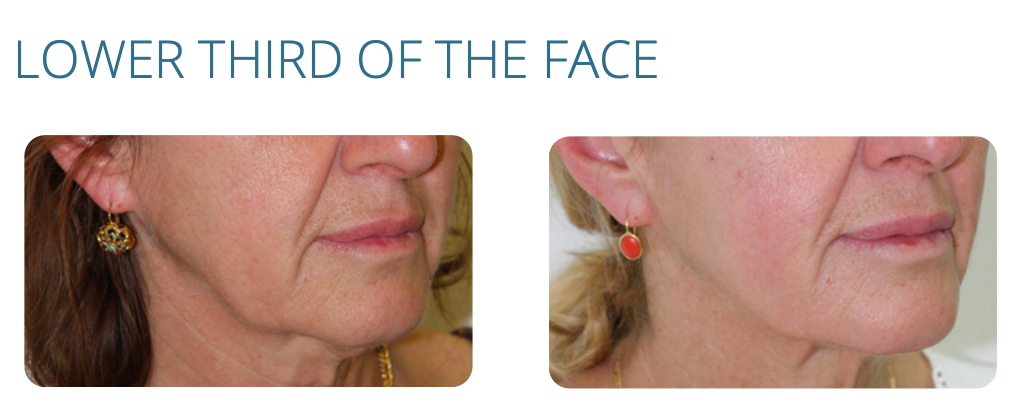 Before and after photos of a woman's lower face, showing a reduction in wrinkles.