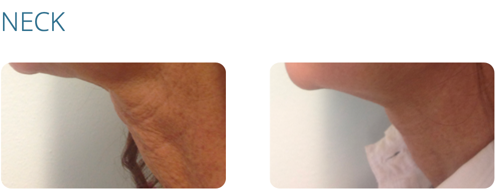 Comparison of a neck with wrinkles and a smoother neck.