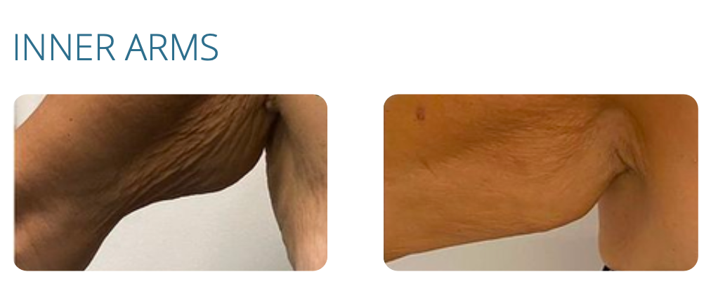 Before and after photos of inner arms; loose, wrinkled skin on the left, smoother on the right.
