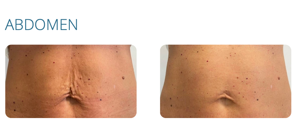 Before-and-after photos of an abdomen. The before shows deep wrinkles, the after shows smoother skin.