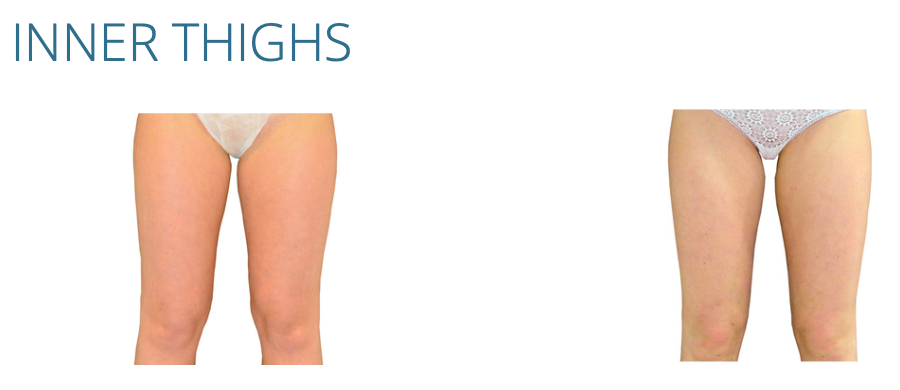 Comparison of inner thighs before and after treatment, showing visible difference in appearance.