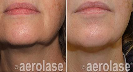 Before and after photos of a woman's lower face, showing a reduction in skin discoloration and improved jawline definition.