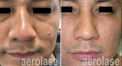 Before and after photos of a man's face, acne scars reduced with laser treatment, skin smoother.