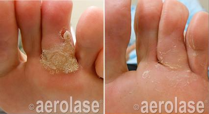 Left foot with wart before treatment and healed foot after treatment.