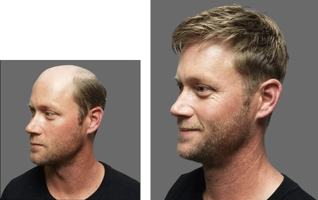 Men's hair replacement systems hair piece before and after