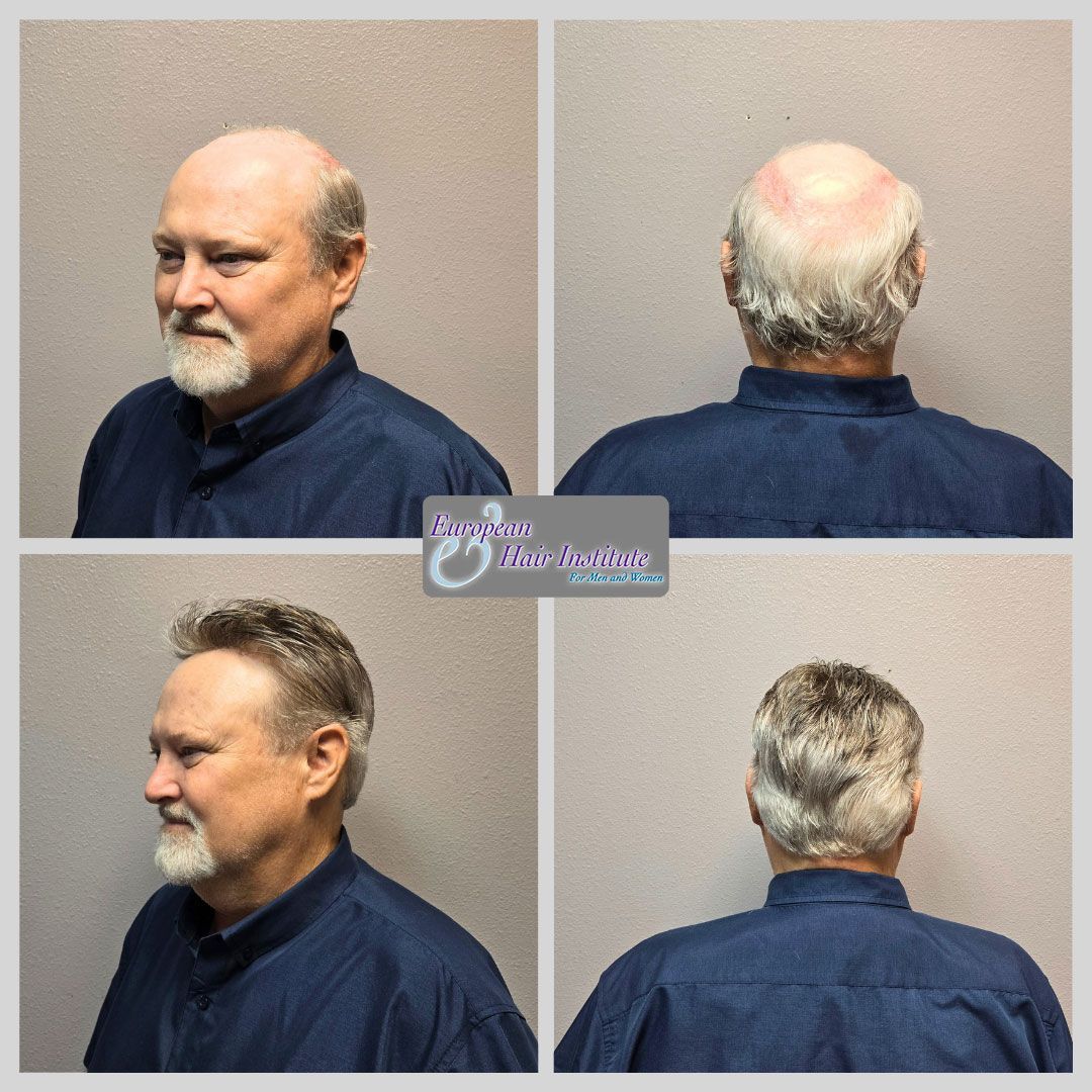 Men's hair replacement systems before and after image.