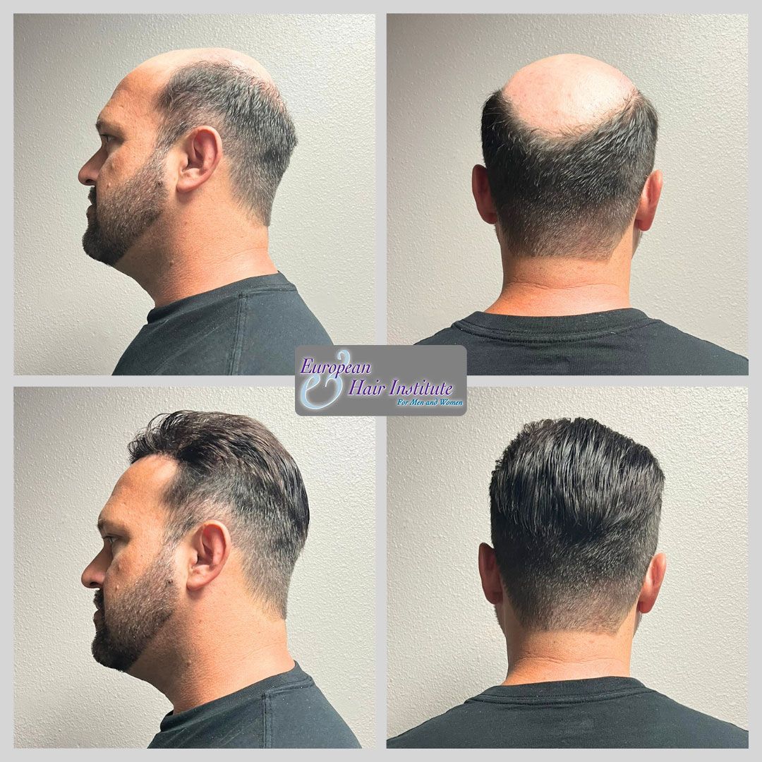 Men's hair replacement systems before and after image.