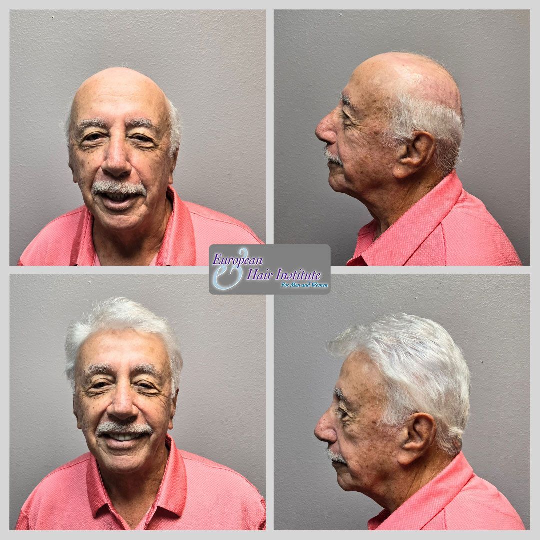 Men's hair replacement systems before and after image.