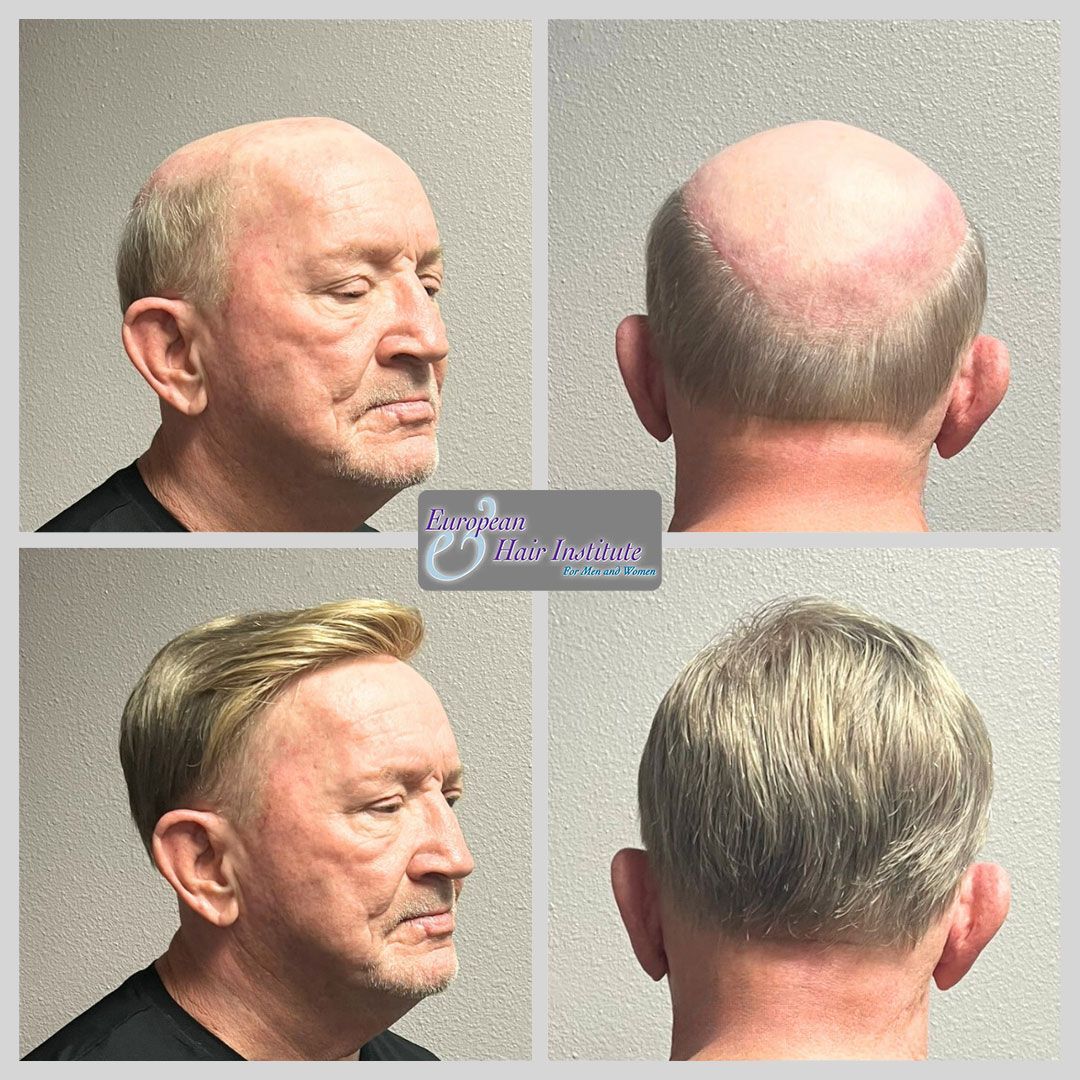 Men's hair replacement systems before and after image.