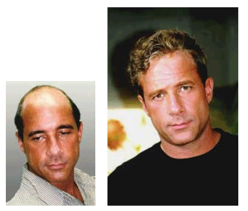 Men's hair replacement systems before and after