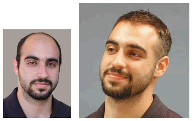 Men's hair replacement systems hair piece before and after