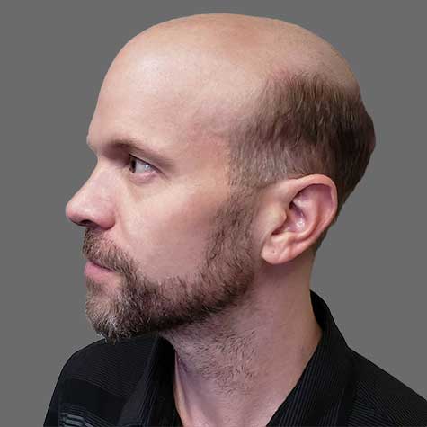 men's hair replacement systems before placement
