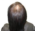 Thinning Hair Women's Hair replacement Solutions