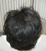 Thinning Hair Women's Hair replacement Solutions
