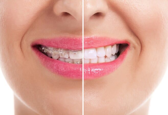 Teeth with Brace Before and After - Dentist in Olympia, WA