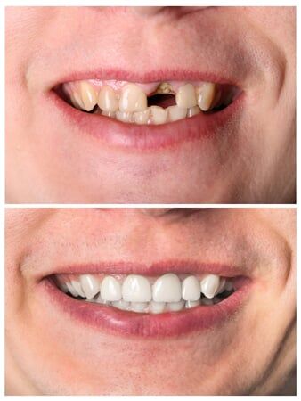 Broken Teeth Before and After - Dentist in Olympia, WA