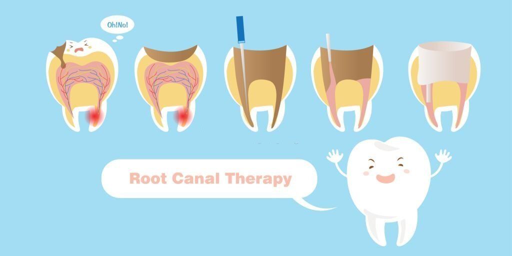 Which Step In Root Canal Therapy Takes Place First