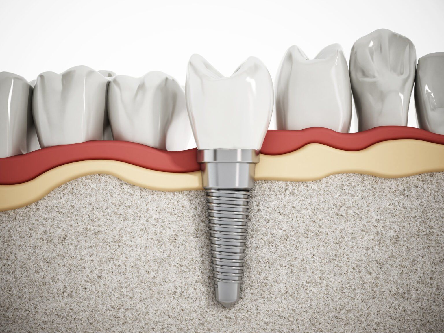 Why You Should Choose Dental Implants?