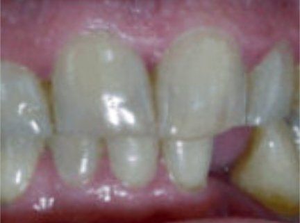 Before Dental Implants
