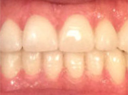 Teeth  After
